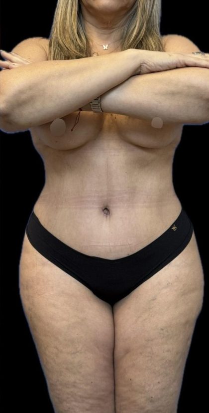 Tummy Tuck Before & After Patient #1614