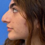 Rhinoplasty Before & After Patient #1617