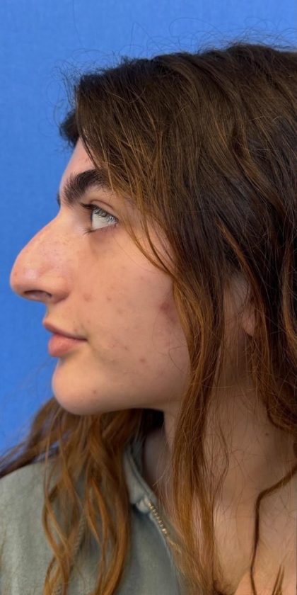 Rhinoplasty Before & After Patient #1617