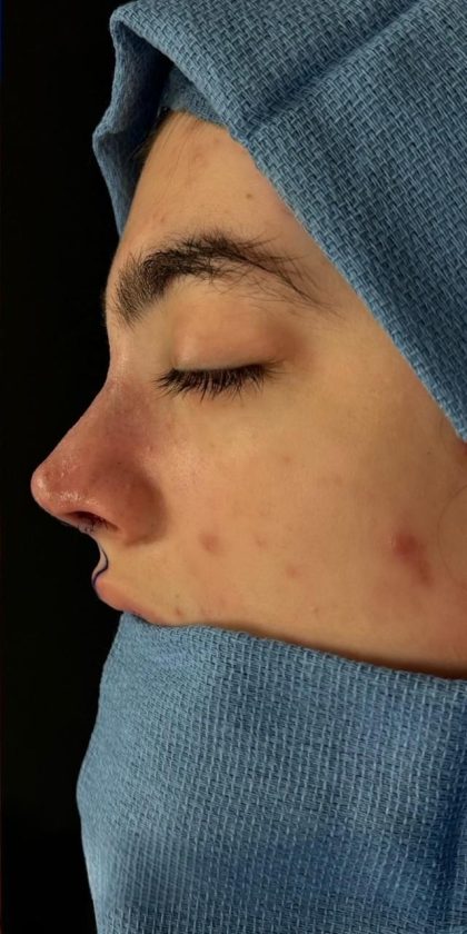 Rhinoplasty Before & After Patient #1617