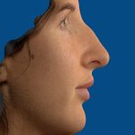 Vectra Before & After Patient #2274