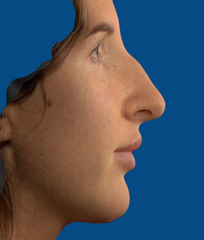 Vectra Before & After Patient #2274