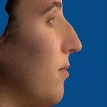 Vectra Before & After Patient #2271