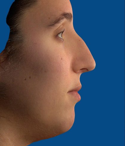Vectra Before & After Patient #2271