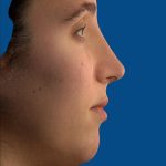 Vectra Before & After Patient #2271
