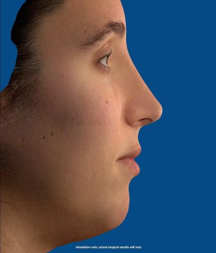 Vectra Before & After Patient #2271