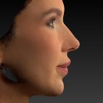 Vectra Before & After Patient #2273