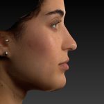 Vectra Before & After Patient #2272