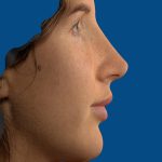 Vectra Before & After Patient #2274