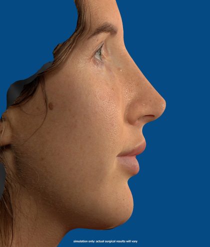Vectra Before & After Patient #2274