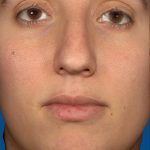 Vectra Before & After Patient #2271