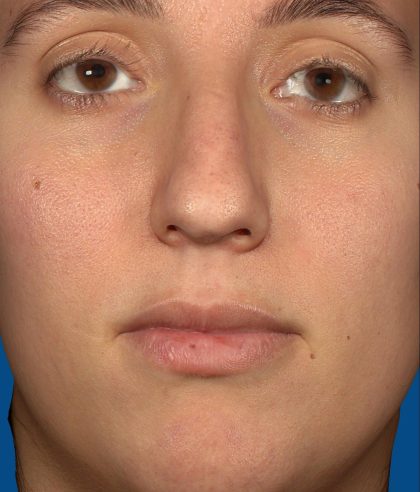 Vectra Before & After Patient #2271