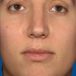 Vectra Before & After Patient #2271
