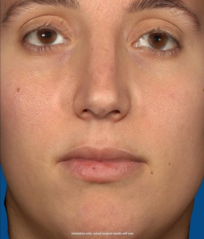 Vectra Before & After Patient #2271
