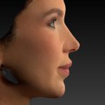 Vectra Before & After Patient #2273