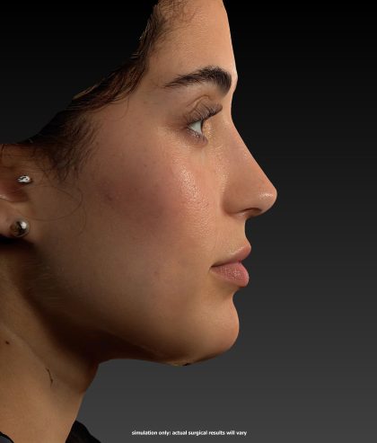Vectra Before & After Patient #2272