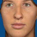 Vectra Before & After Patient #2274