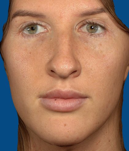 Vectra Before & After Patient #2274