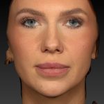 Vectra Before & After Patient #2273