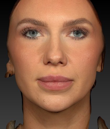 Vectra Before & After Patient #2273