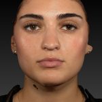 Vectra Before & After Patient #2272