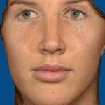 Vectra Before & After Patient #2274