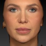 Vectra Before & After Patient #2273