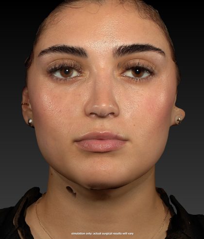 Vectra Before & After Patient #2272